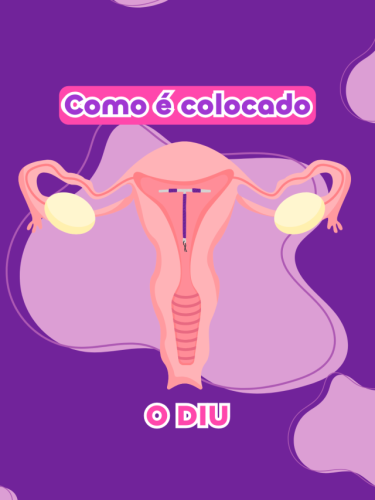 como é colocado o diu?